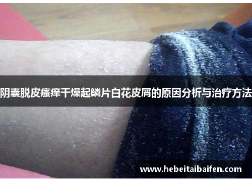 阴囊脱皮瘙痒干燥起鳞片白花皮屑的原因分析与治疗方法